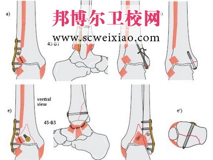 骨折愈合期从哪些方面进行康复治疗