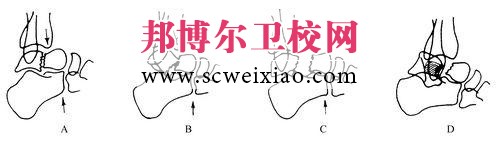 骨折固定期从哪些方面进行康复护理